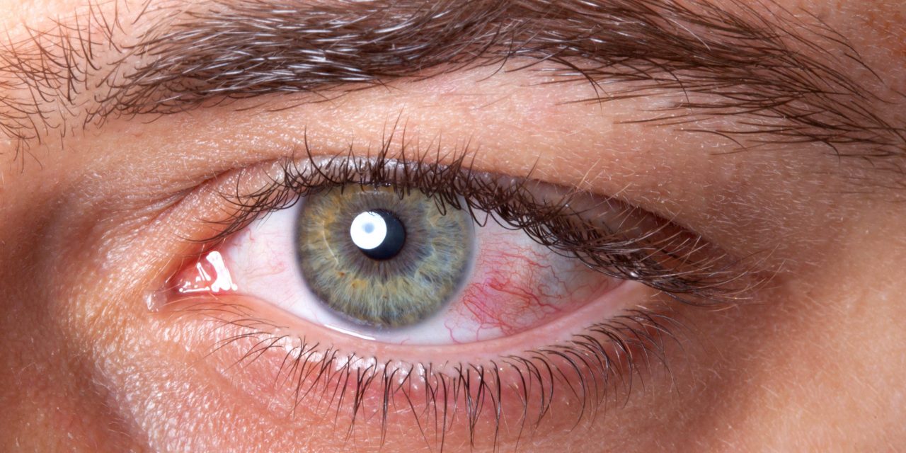 Irritated red bloodshot eye